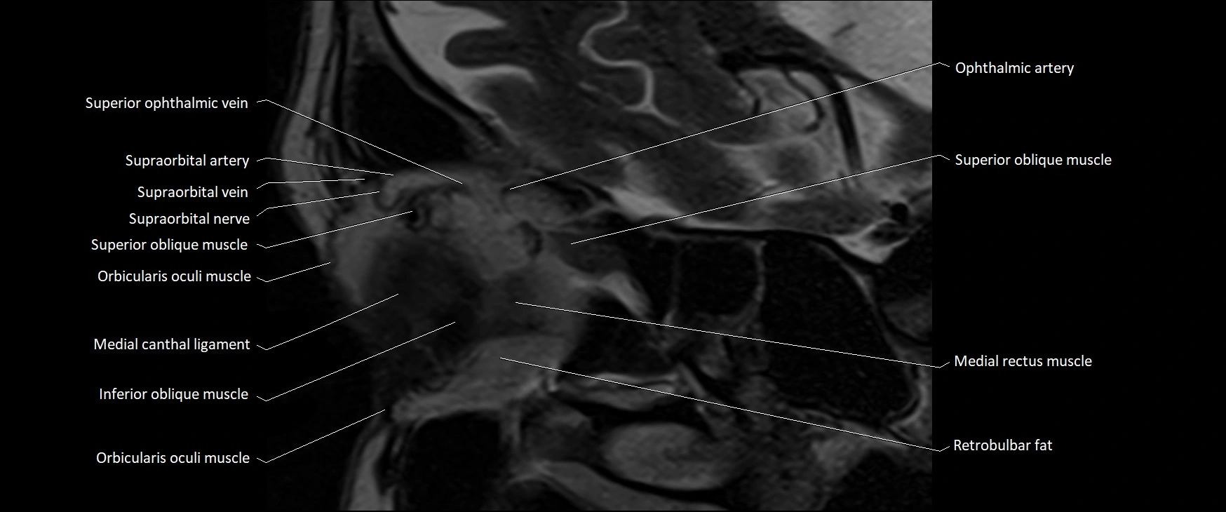 MRI Orbit sagittal cross sectional anatomy 3T image 4.webp